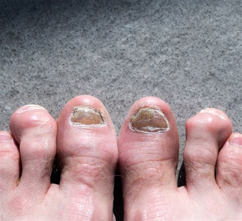 ugly feet pics|Ugly Feet Photos, Download The BEST Free Ugly。